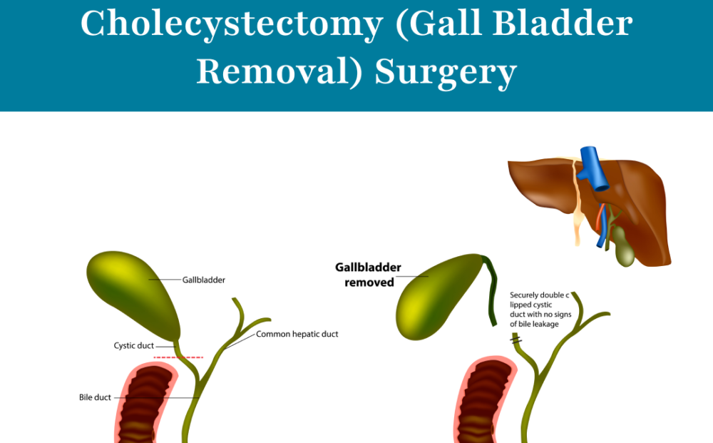 cholecystectomy-procedure