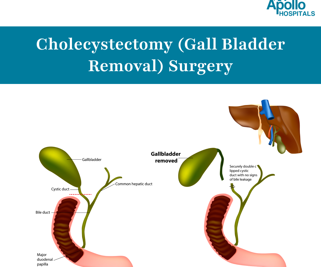 cholecystectomy-procedure